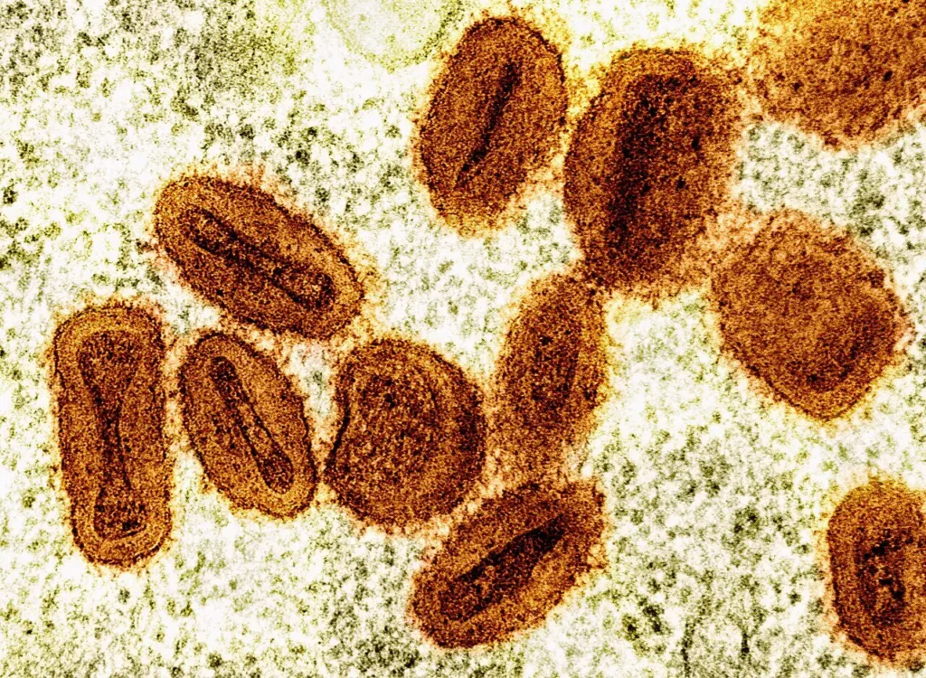 Ceará confirma terceiro caso de Mpox em 2026, saiba mais aqui